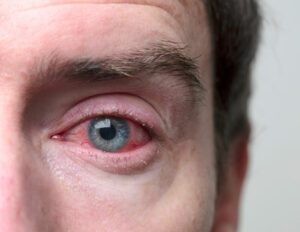 homme atteint de conjonctivite gros plan sur oeil rouge infecté